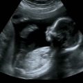 bebek ultrason