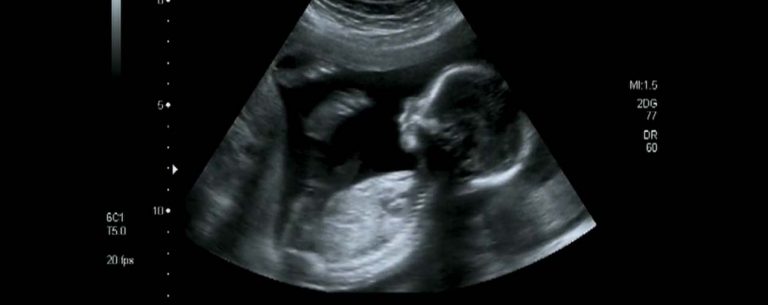 bebek ultrason