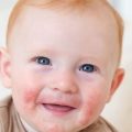 bebeklerde besin alerjisi 1