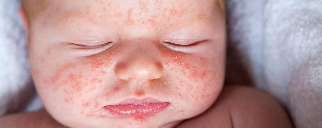 bebeklerde besin alerjisi 4