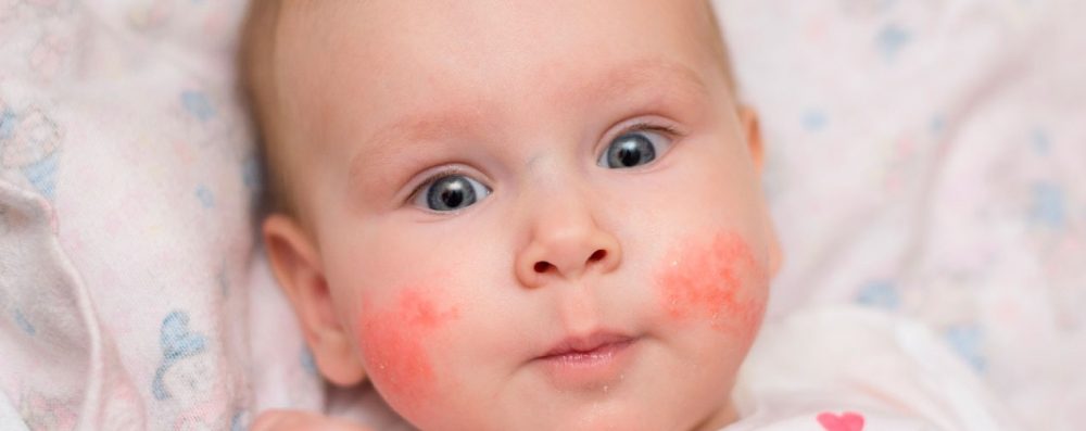 bebeklerde sut alerjisi 1