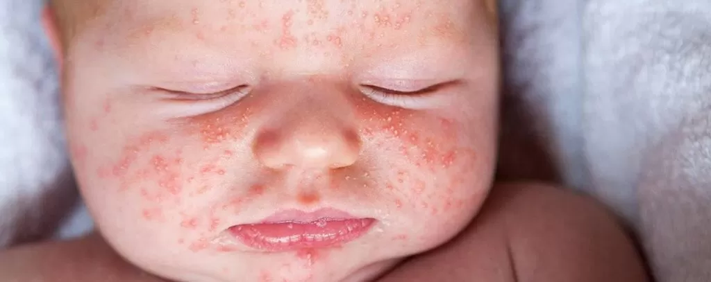 bebeklerde sut alerjisi 2