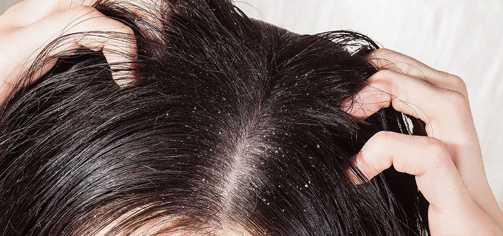 Hint yağının saça faydaları - Kepek ve saç derisi enfeksiyonlarını tedavi eder