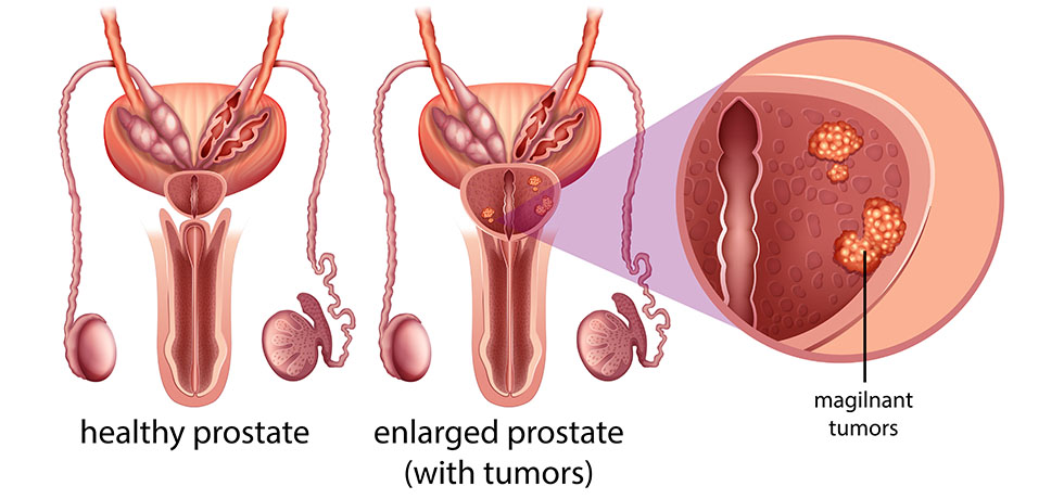 Prostat Kanserinin Nedenleri