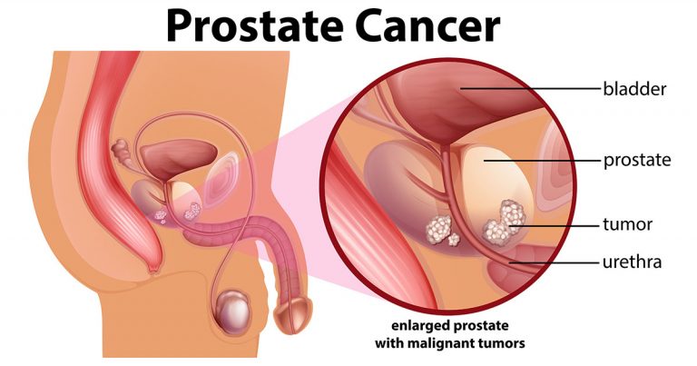 prostat-kanseri-nedir