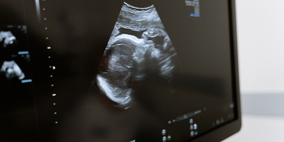 On Dokuz Haftalık Gebelikte Bebek Ultrason Görüntüsü