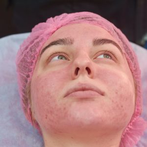 Face of young woman, acne